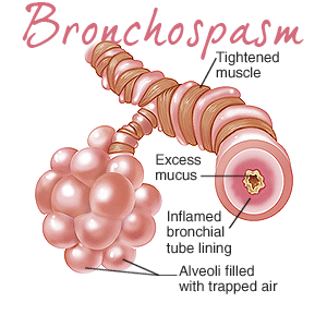 bronchospam